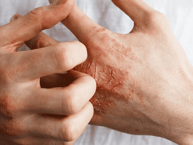 eczema_0002_AdobeStock_137327355