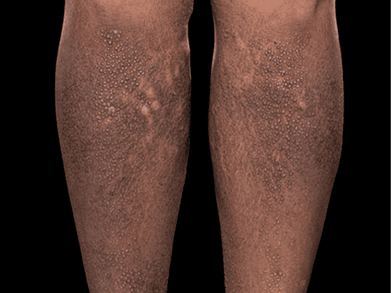 eczema_0005_Lichen-amyloid-eczema-large