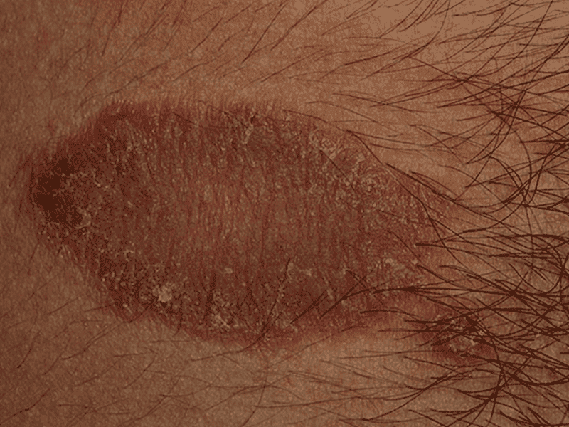 eczema_0006_Discoid-Eczema-large