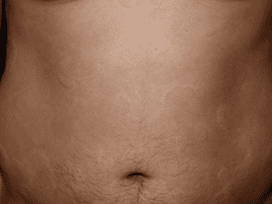 hives_0000_hives-300x225