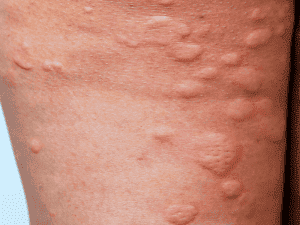hives_0002_AdobeStock_243131546-300x225