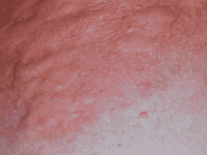 hives_0003_AdobeStock_242794575-300x225