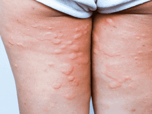 hives_0004_AdobeStock_236739309-300x225