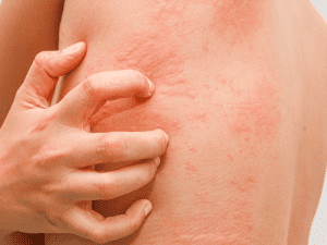 hives_0006_AdobeStock_119502501-300x225