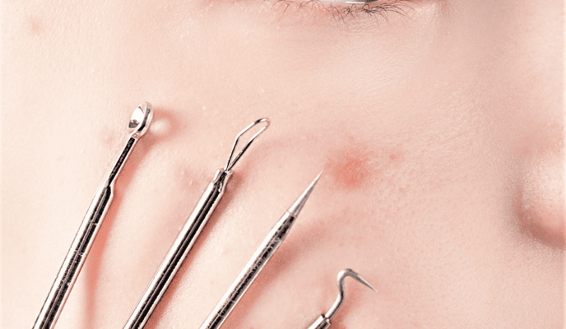 How To Get Rif Of Acne Scars With Subcision E1653641770422