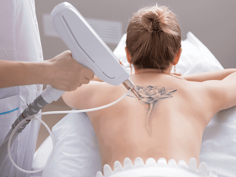 How to Remove Your Tattoo | Men's Health