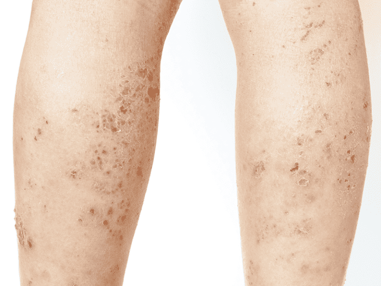 lichen-planus