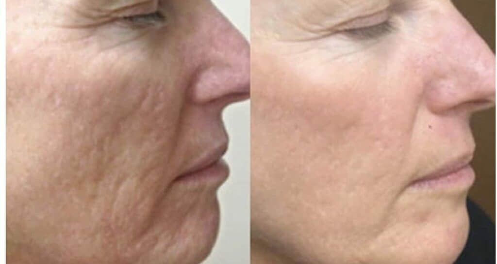 prp-before-and-after-e1665390159255