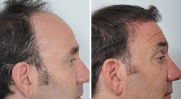 prp-hair-treatment-for-men-e1665390519598