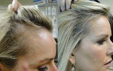 prp-hair-treatment-for-women-e1665390223632