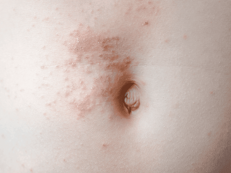scabies