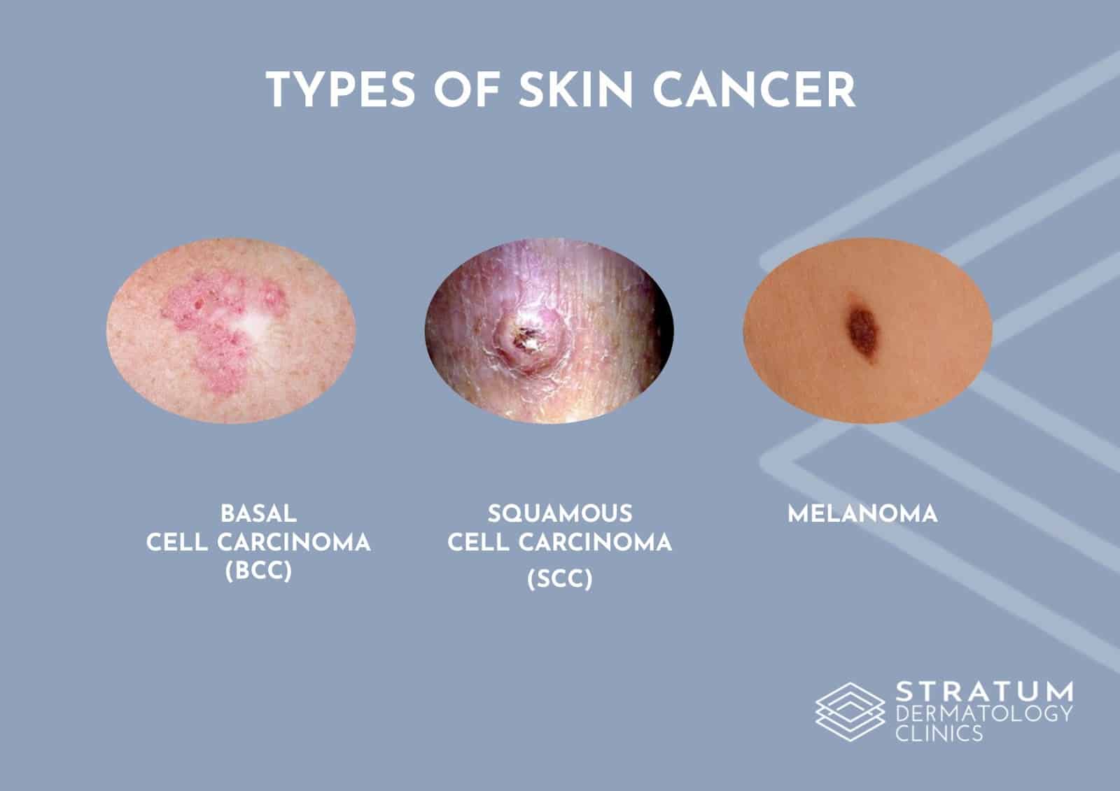 What are common types of skin cancer? Stratum Clinics