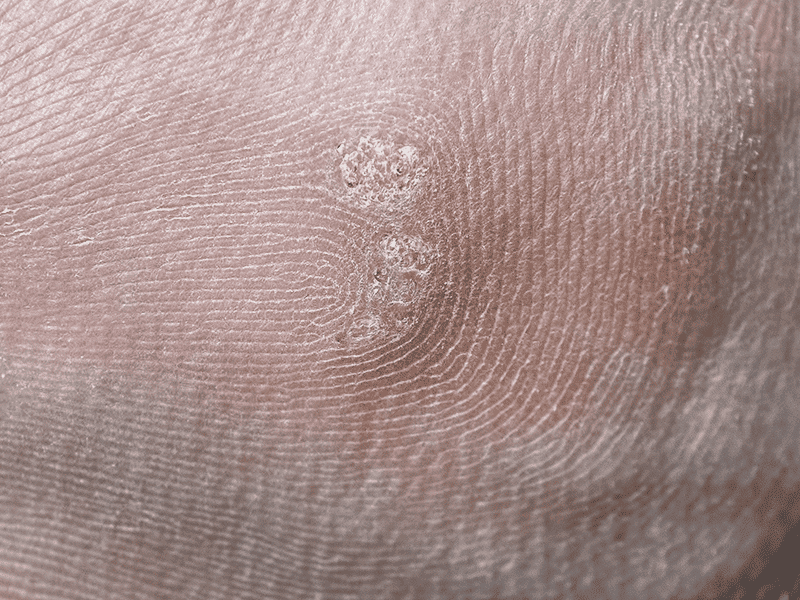 wartsandverrucas_0000_AdobeStock_262601665
