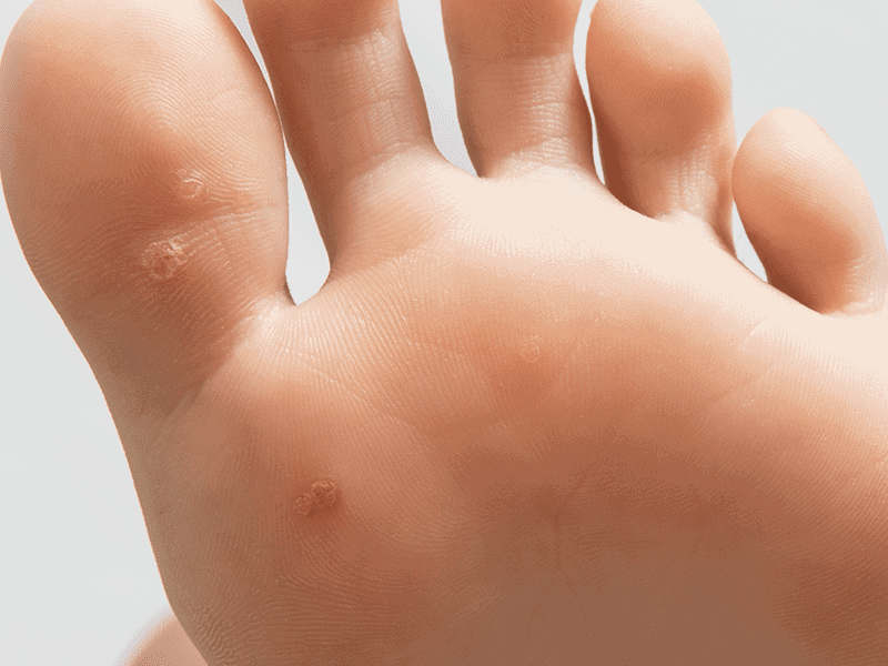 wartsandverrucas_0001_AdobeStock_243290969