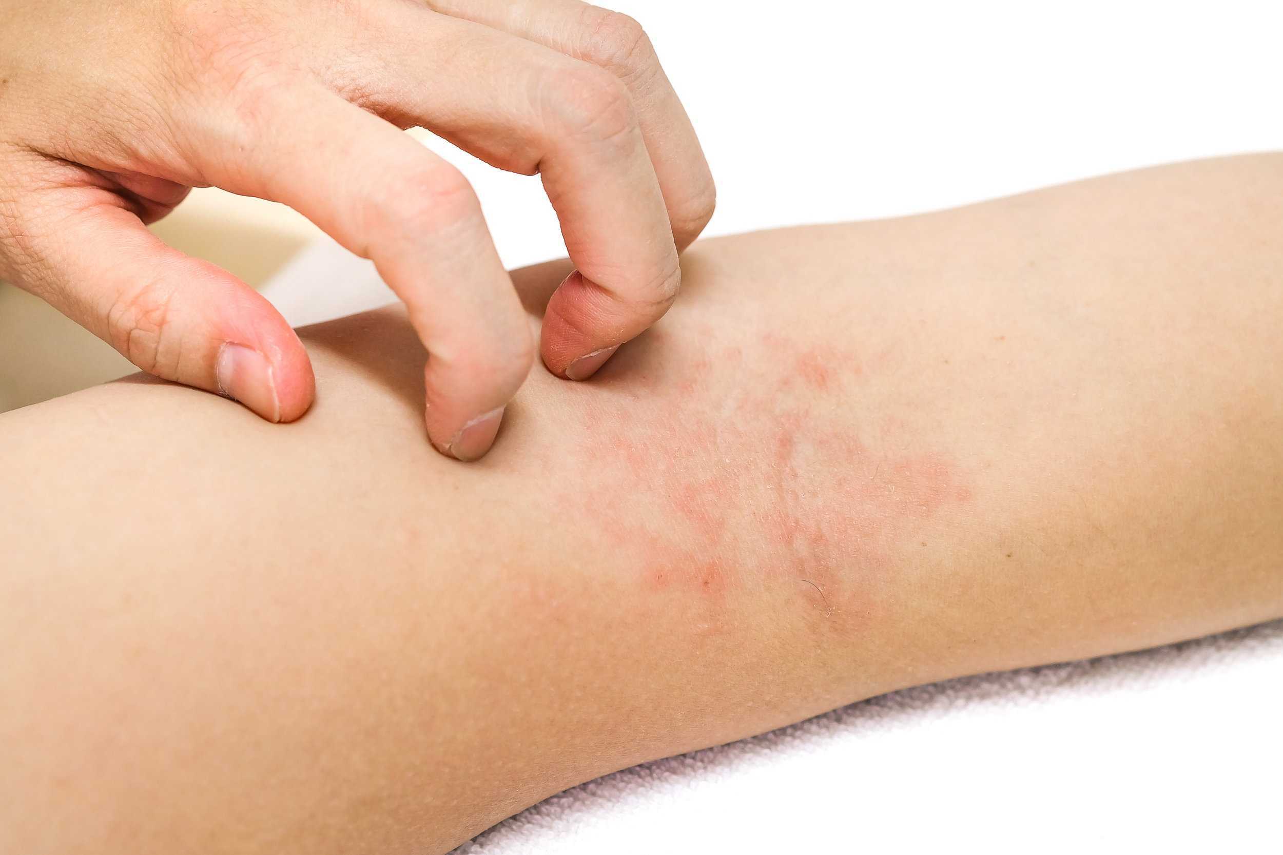 Eczema And Skin Rashes
