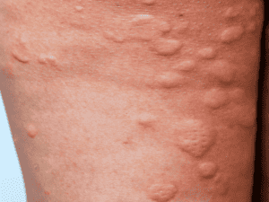 Hives Thumb 300x225