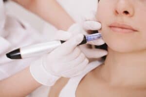 Microneedling 300x200