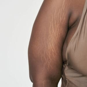 Rsz Stretch Marks 300x300