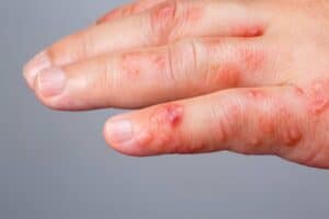 Scabies 300x200