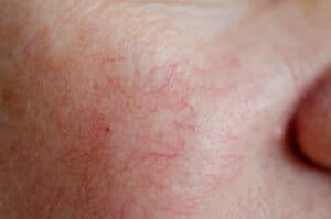 Spider Veins Thread Vein And Rosacea 300x199