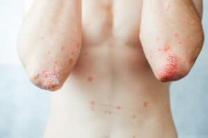 Psoriasis 300x199