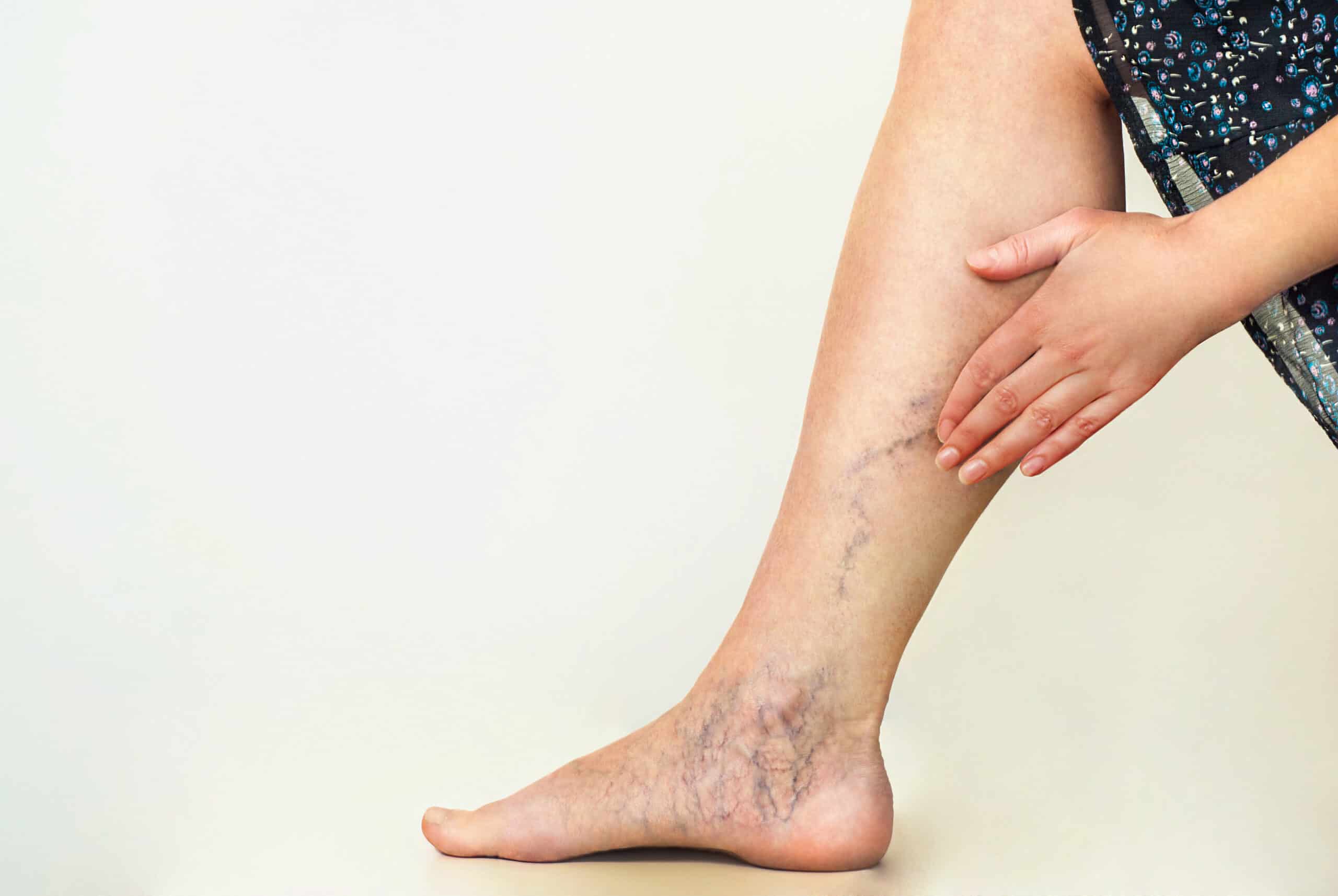 Varicose Veins Causes Symptoms And