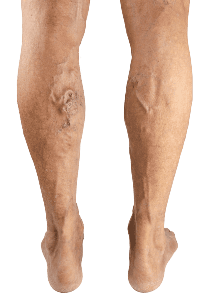 varicose vein treatment near me