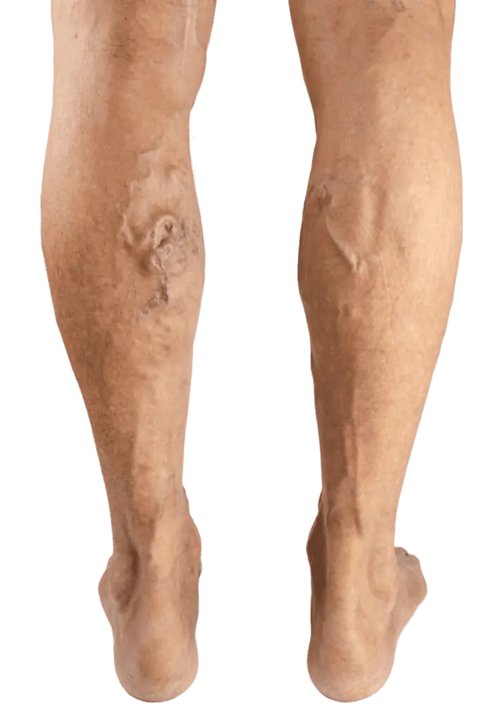 varicose vein treatment near me