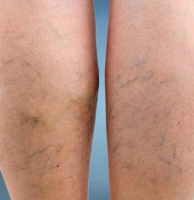 thread veins treatment