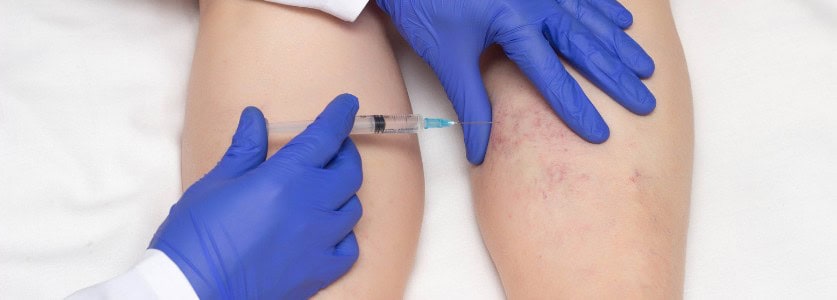 Foam sclerotherapy near me