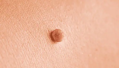 Skin tag removal