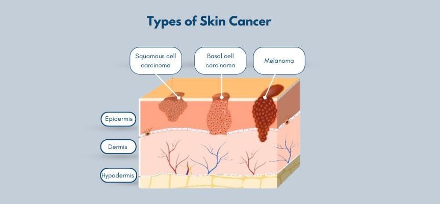 Melanoma Treatment