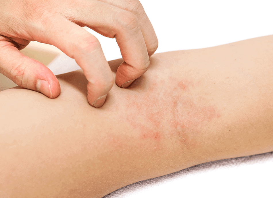 eczema_0001_AdobeStock_176541850