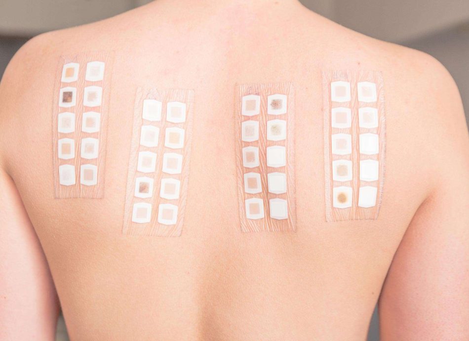 skin allergy patch testing